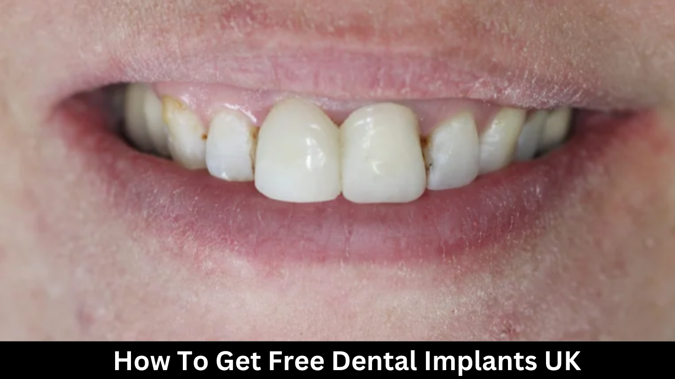 How To Get Free Dental Implants UK